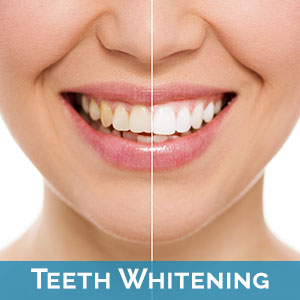 Teeth Whitening near Buffalo Grove