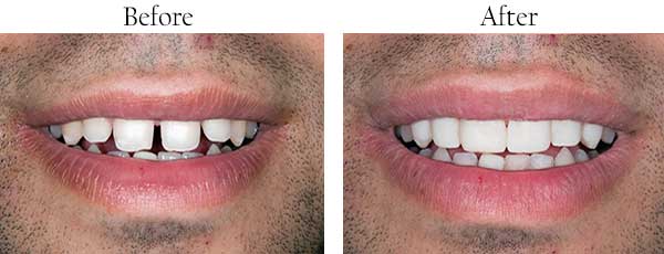 60010 Before and After Dental Crowns