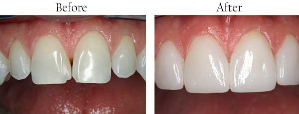 Buffalo Grove Before and After Invisalign